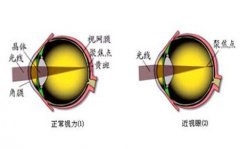 近视眼会引起哪些并发症？