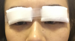 重睑术术后需要做的“善后”