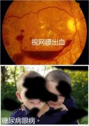 糖尿病视网膜病变解惑