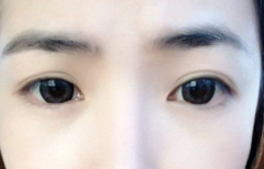 你对重睑术了解多少？
