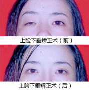 上睑下垂手术是越早做越好吗？