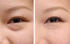 两种去眼袋方法的适用人群