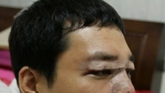 男士割双眼皮的切开法