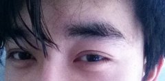 男士割双眼皮的术后注意事项