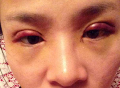 双眼皮手术（重睑术）疤痕修复
