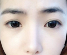 导致双眼皮手术失败的几大原因