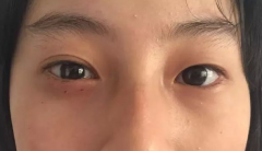 眼眶皮样囊肿的诊断与治疗