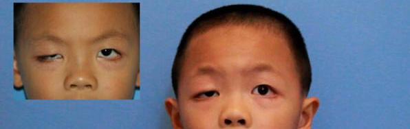 孩子患上睑下垂有什么危害？一定