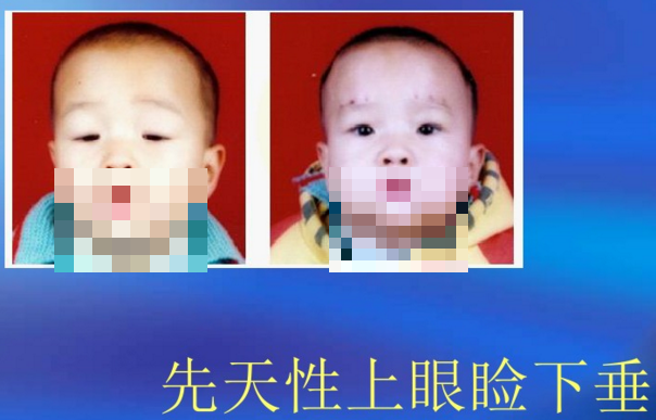 孩子先天性上睑下垂治疗时机