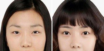 上眼睑下垂主要形成的几个原因