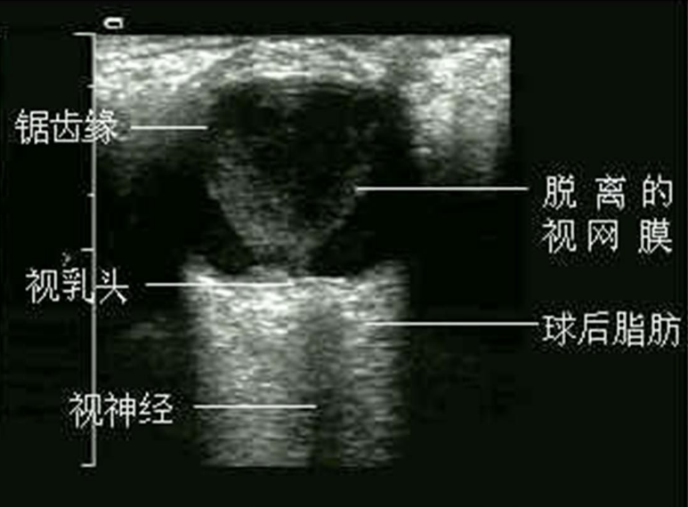 糖尿病视神经病变