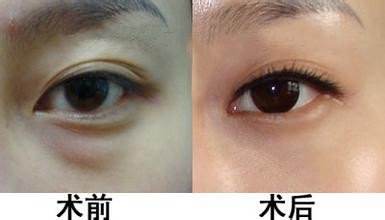 眼袋的四种类型及解决方法