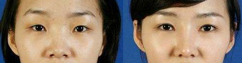 有几种手术方法可以矫正眼袋？