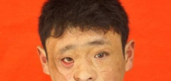 睑外翻临床表现