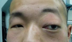 眶内海绵状血管瘤检查类别
