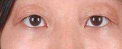 眼睑皮肤弛缓症的临床表现都有哪