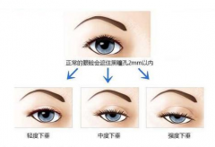 发生上睑下垂应该怎么办？