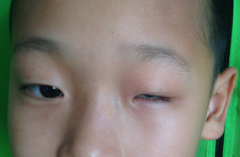 真性小眼球的病因与临床表现